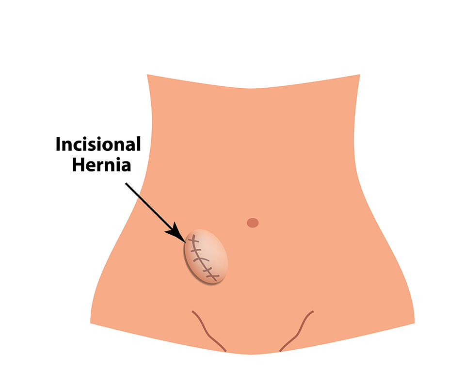 Incisional Femoral Hernias Occur Just Below The Inguinal Ligament