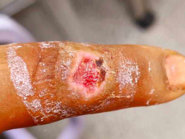 finger with diabetic wound