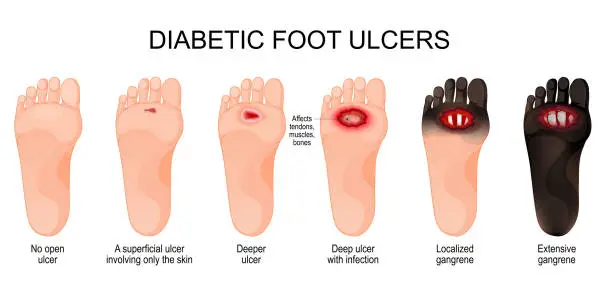 images of feet with different types of foot ulcers