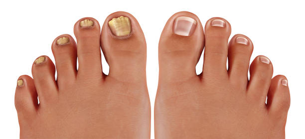 Fungus in the nail treatment at Kapadia Hospital Mumbai showing nail fungus symptoms diagnosis and podiatry care