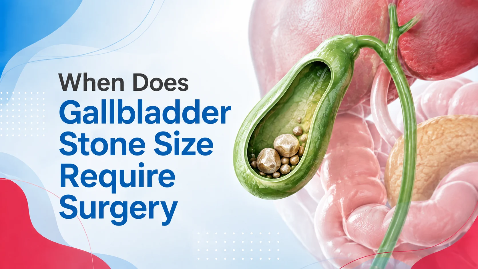 Gallbladder stone size chart showing when gallstone surgery may be needed at Kapadia Hospital Mumbai