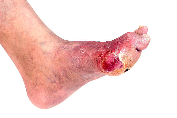 Diabetic wound on the feet