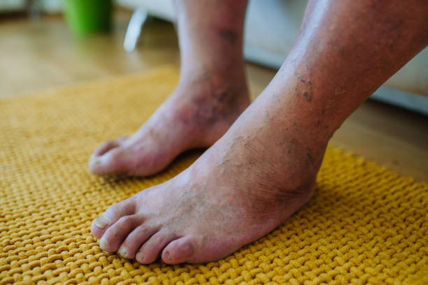 Diabetic foot wound treatment at Kapadia Hospital Mumbai showing advanced wound care and healing