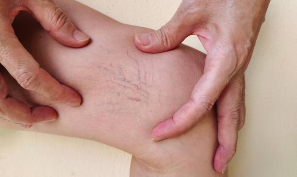 Is laser treatment for varicose veins safe explained by vascular specialists at Kapadia Hospital Mumbai