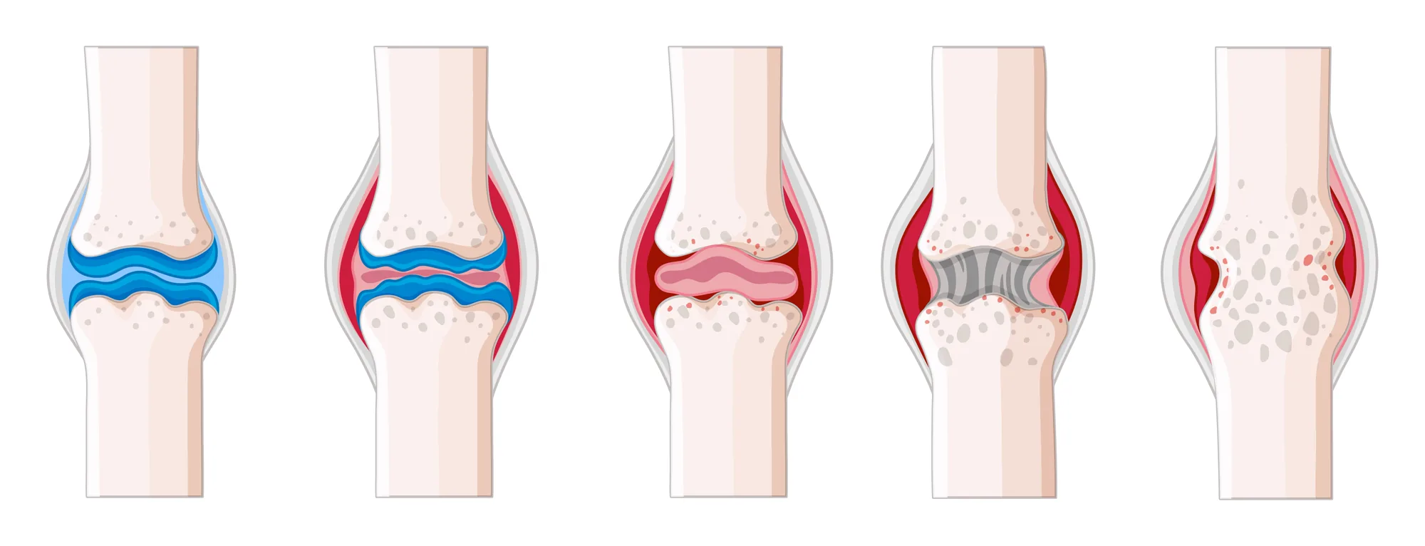 Knee Replacement Procedure Steps