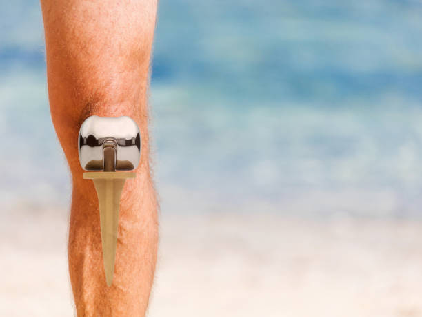 see through image of a man's knee which had a knee replacement