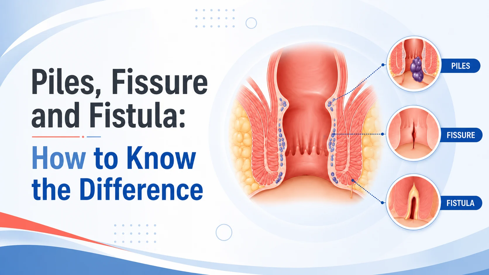 Piles vs fissure vs fistula difference in symptoms causes and treatment at Kapadia Hospital Mumbai