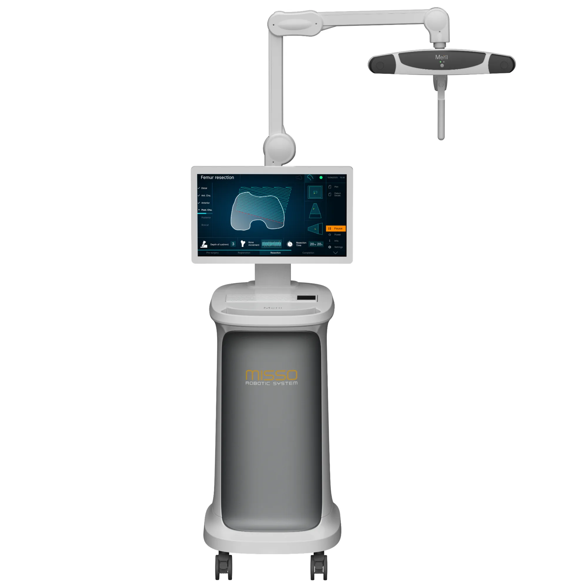 Robotic knee replacement surgery in Mumbai using the Misso Robotic System at Kapadia Hospital