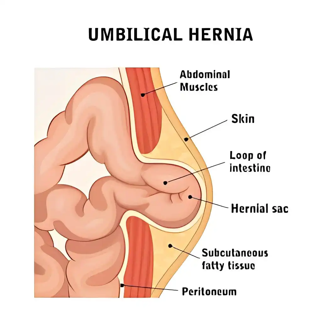 Umbilical Hernia in Adults