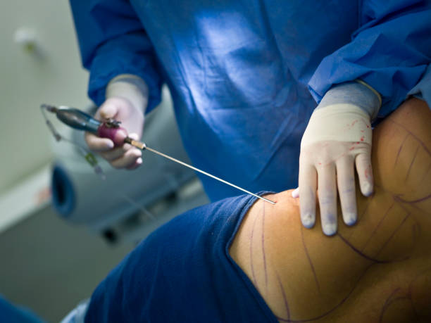 Doctor performing liposuction treatment on a patient at Kapadia Hospital Mumbai