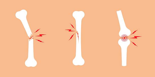 Types of bone fractures including comminuted fracture with multiple splintered bone fragments