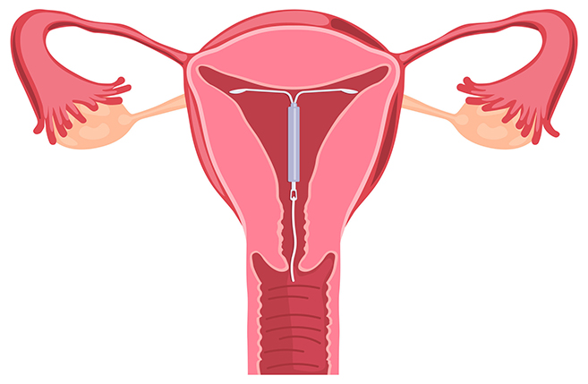 Copper-T intrauterine device used for long-term birth control at Kapadia Hospital, Mumbai