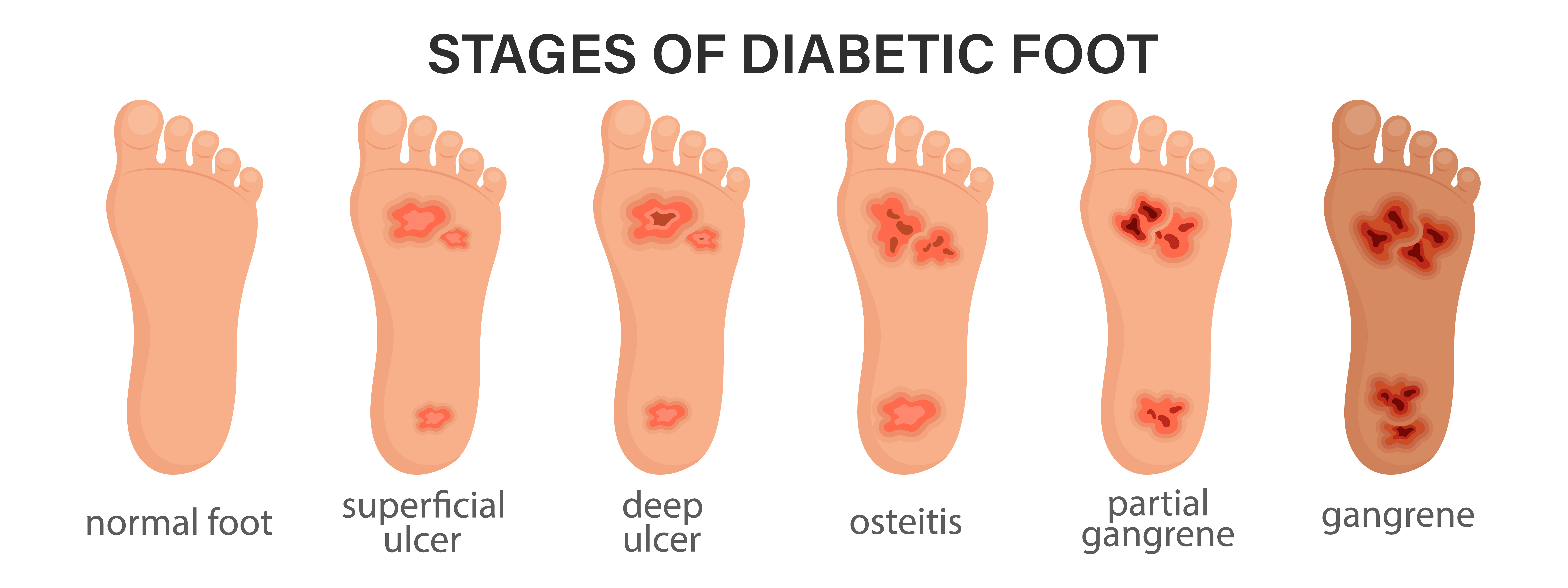 diabetic foot