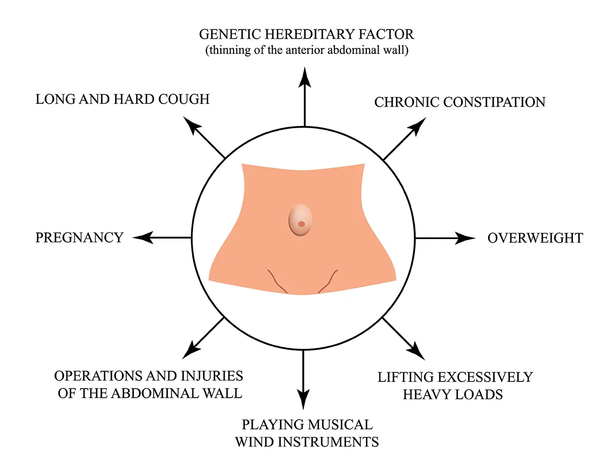 Umbilical Hernia Causes